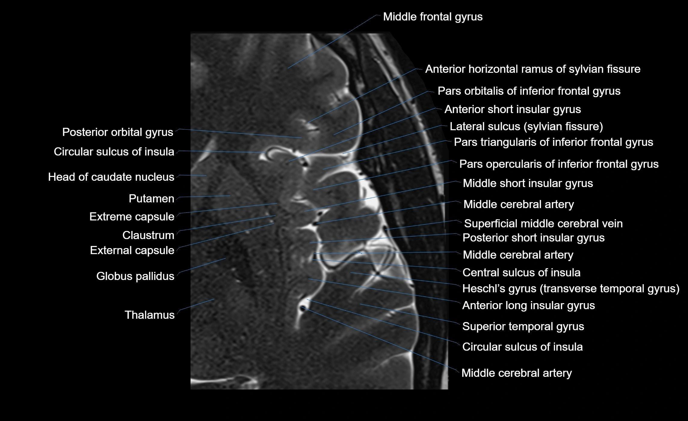 Brain insula axial  anatomy 3T MRI image-img-00001-00010.webp